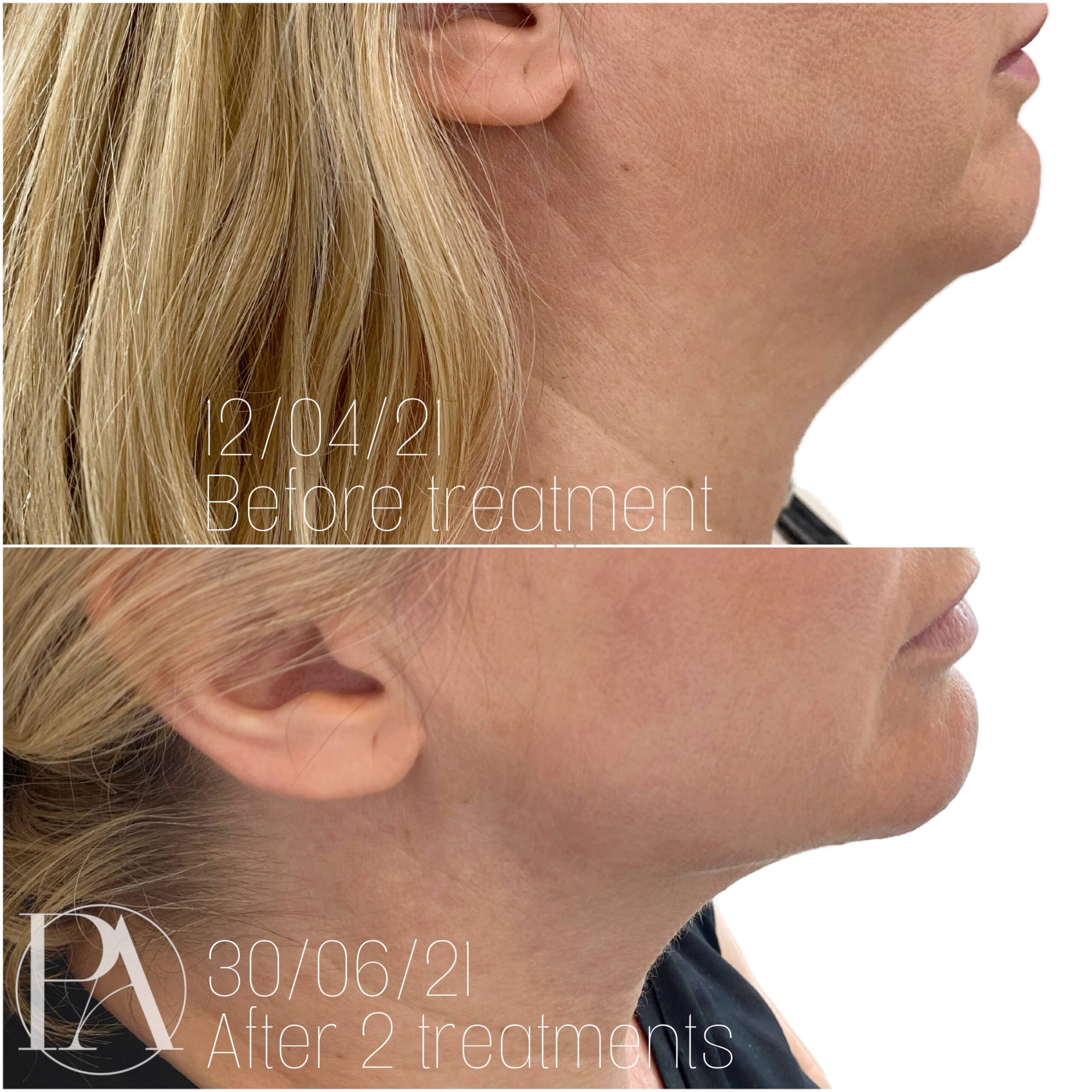 Chin Injections to Reduce Fat Beneath the Jawline