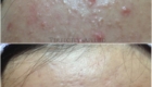 Before And After Acne