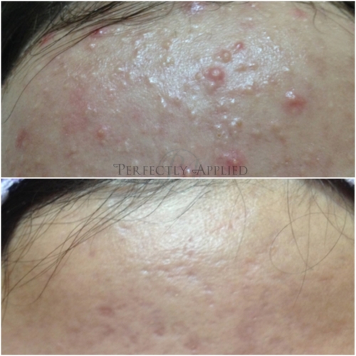 Before And After Acne
