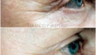 Before And After Crows Feet