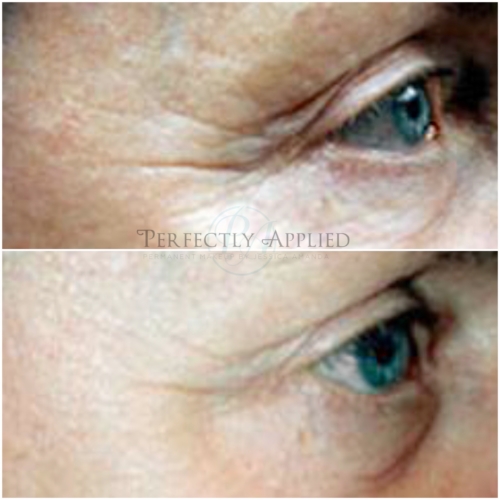 Before And After Crows Feet