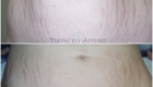 Before And After Tummy Stretch Marks