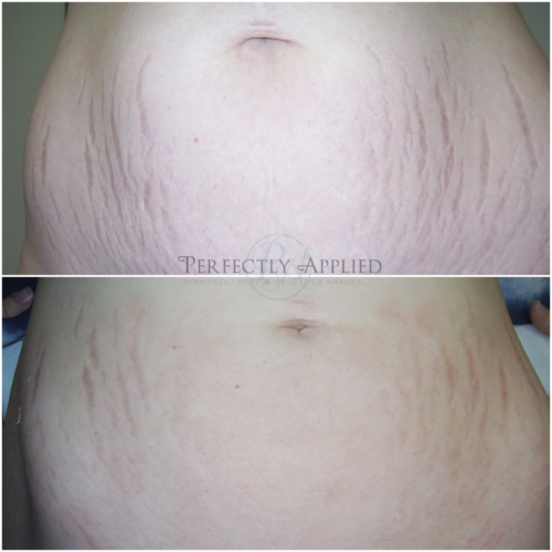 Before And After Tummy Stretch Marks